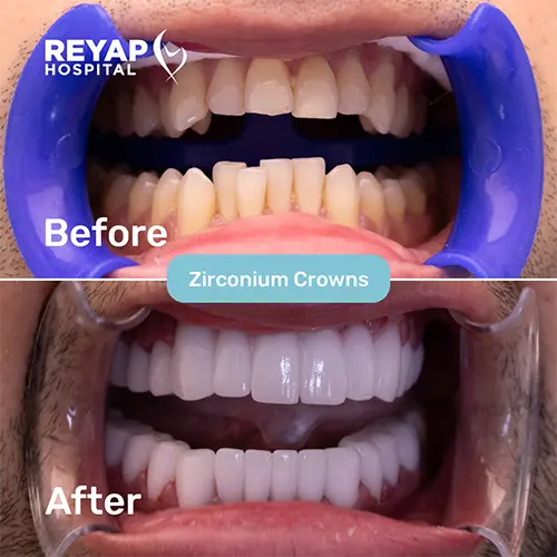 Reyap Hospital Dental patients Before/After Image
