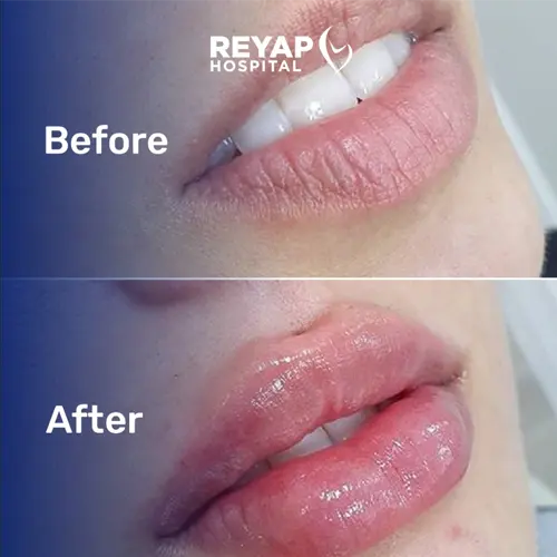 Reyap Hospital Dermatology Before / After