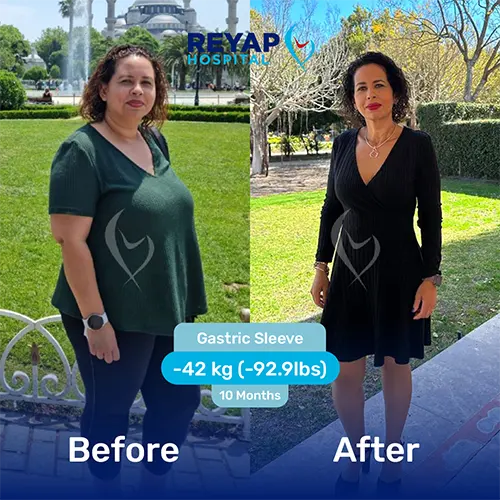 Reyap Obesity Patient Before/After Image
