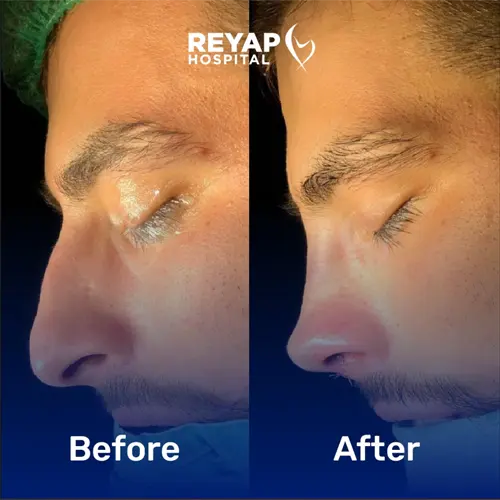 Reyap Hospital Plastic Patient Before/After Image